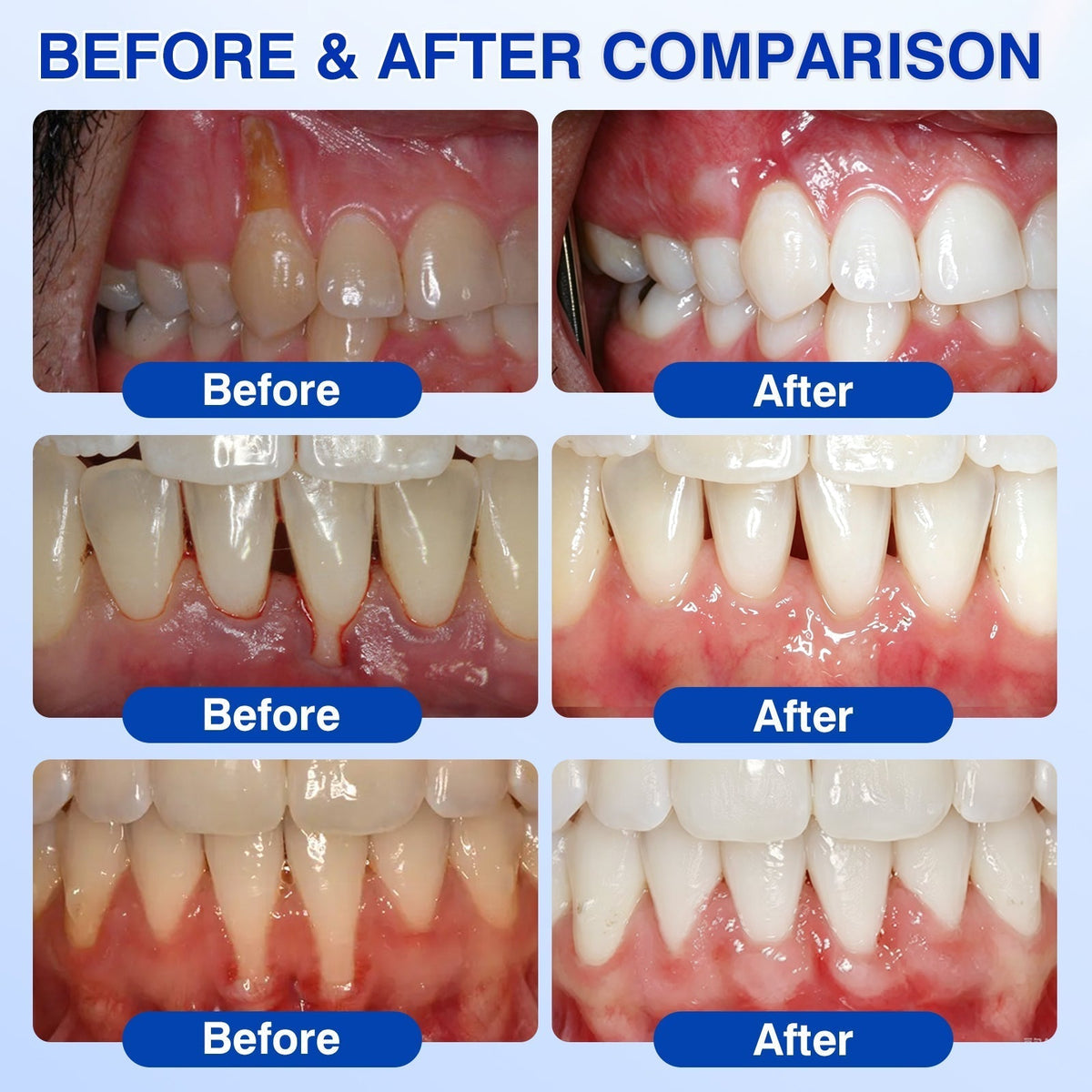 𝐇𝐈𝐒𝐊𝐈𝐍®👩‍⚕️🇨🇦🏅🦷🛡️ HISKIN® GumRevive Periodontal Repair Gel