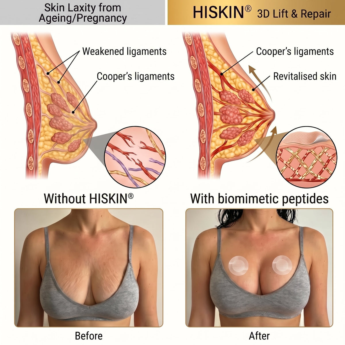 👩‍⚕️ Breast Firming & Fuller-Looking Curves HISKIN® — Advanced Nano-Microneedle Patch for Targeted Care