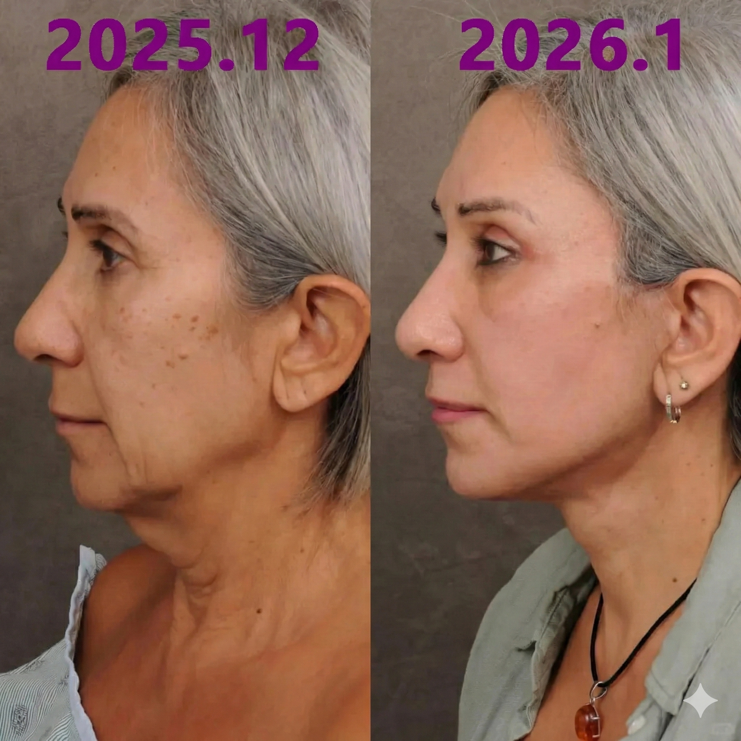 Bestsellerowy krem Solaroza @ Calcium Polycollagen Improvement Cream – zawiera jony wapnia, heksapeptyd-8 oraz ekstrakty z kolagenu roślinnego, które działają na zmarszczki, zapewniając szybką poprawę i 100% efekt przeciwstarzeniowy.